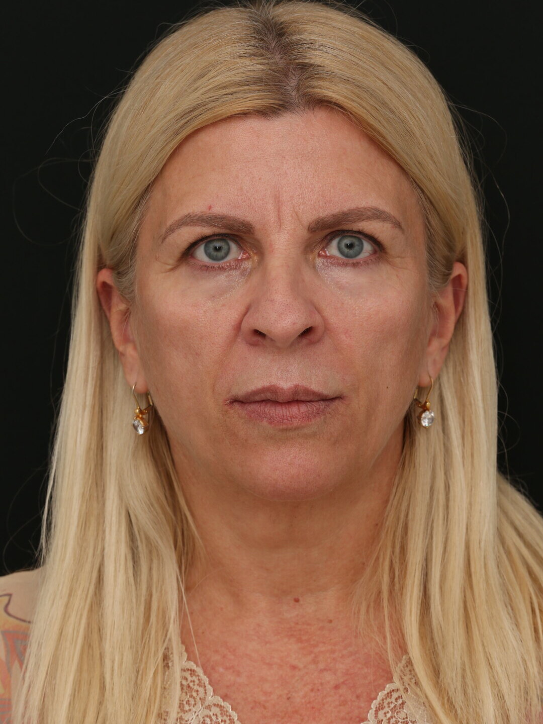Imagem pré-operatória educativa de lifting facial em visão frontal