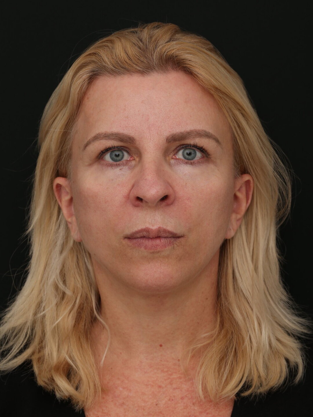 Resultado educativo de lifting facial em visão frontal, com evolução individual
