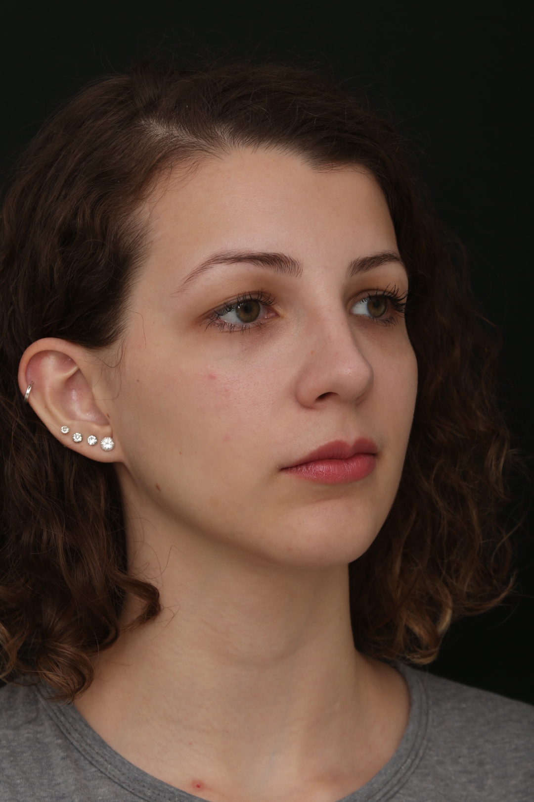 Resultado da rinoplastia